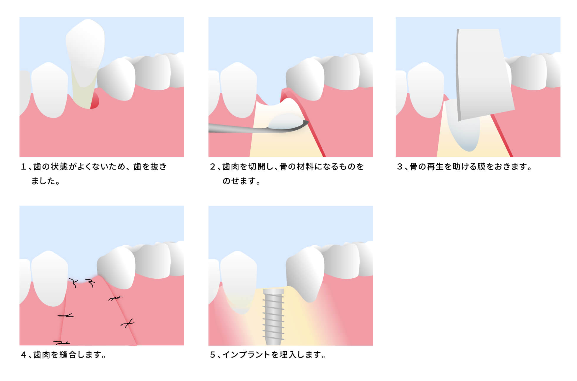 あす楽対応】 矯正が先か? インプラントが先か? 欠損補綴の治療計画を 