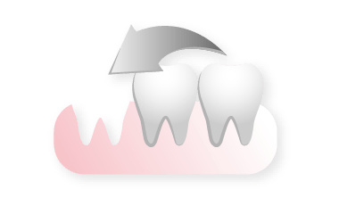 歯牙移植